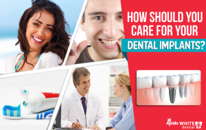 How Should You Care For Your Dental Implants?